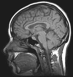 MRI_brain